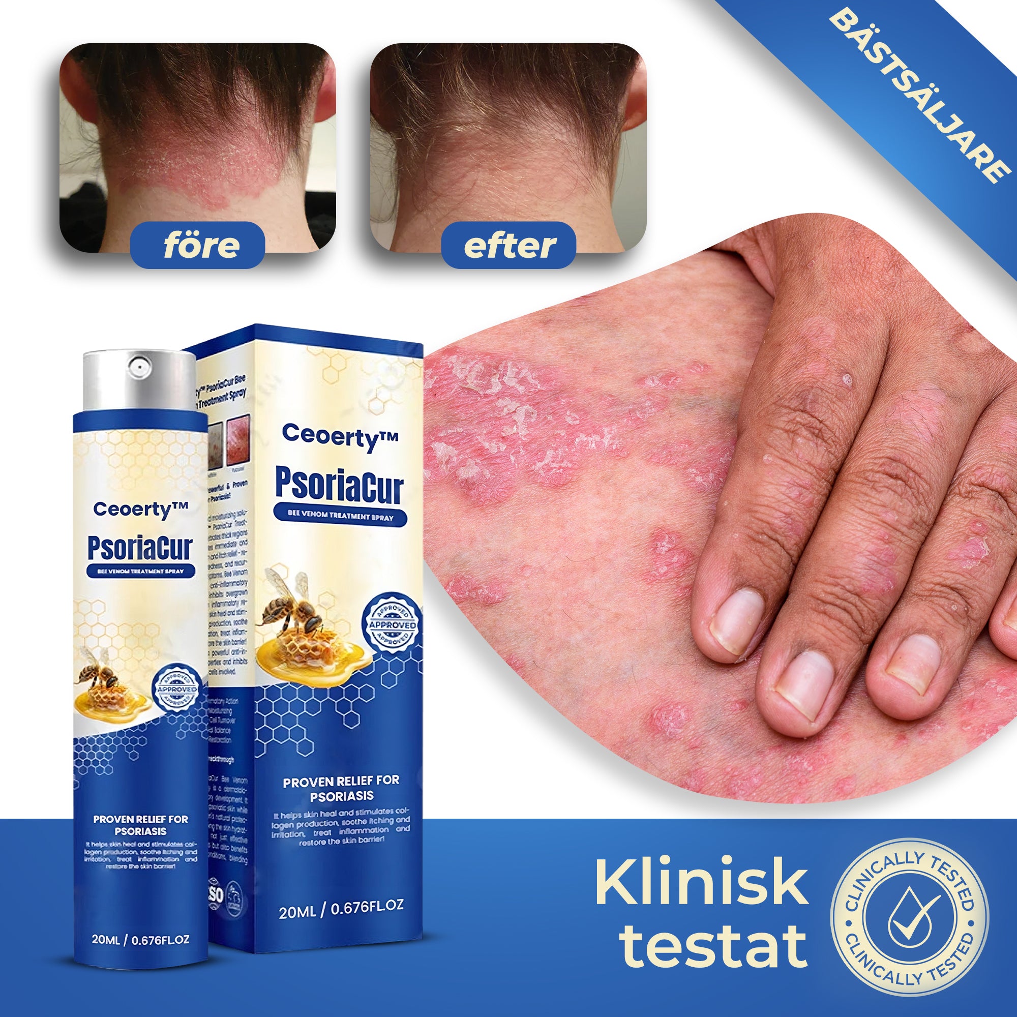 PsoriaEase™ - Spray | Ta bort psoriasisrodnad på 13 dagar, få en slät och klar hud.